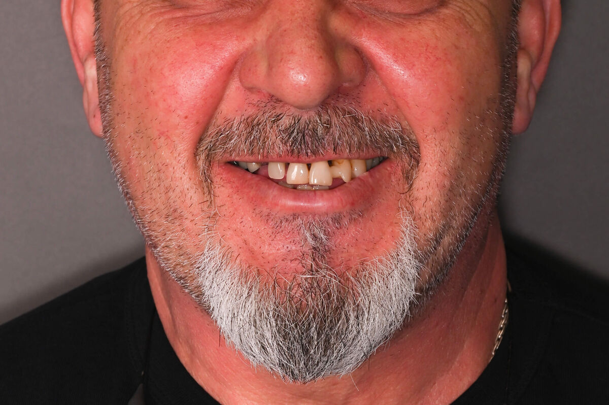 Zâmbet lateral stanga_înainte